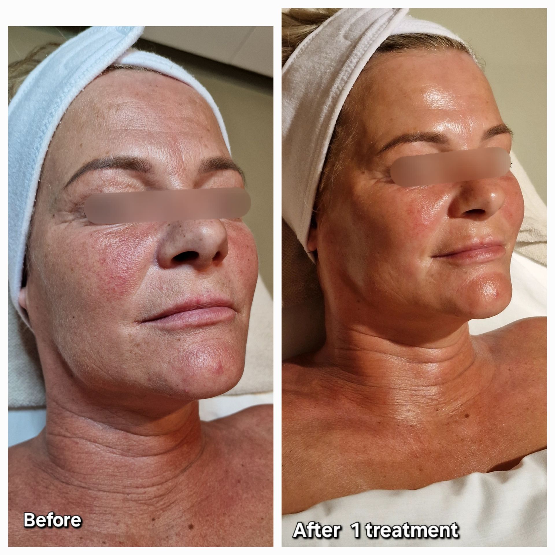 Voor en na Gustil Facial Lifting case 1