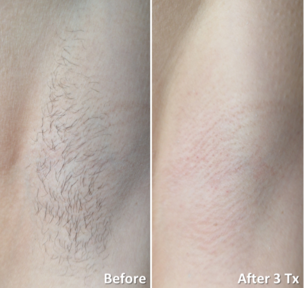 Voor en na laser ontharen oksel