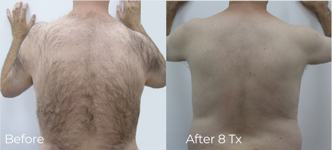 Before and after laser hair removal back