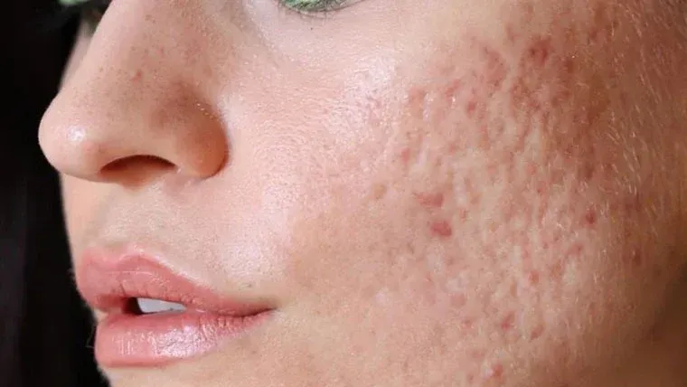 Hyperpigmentation before and after
