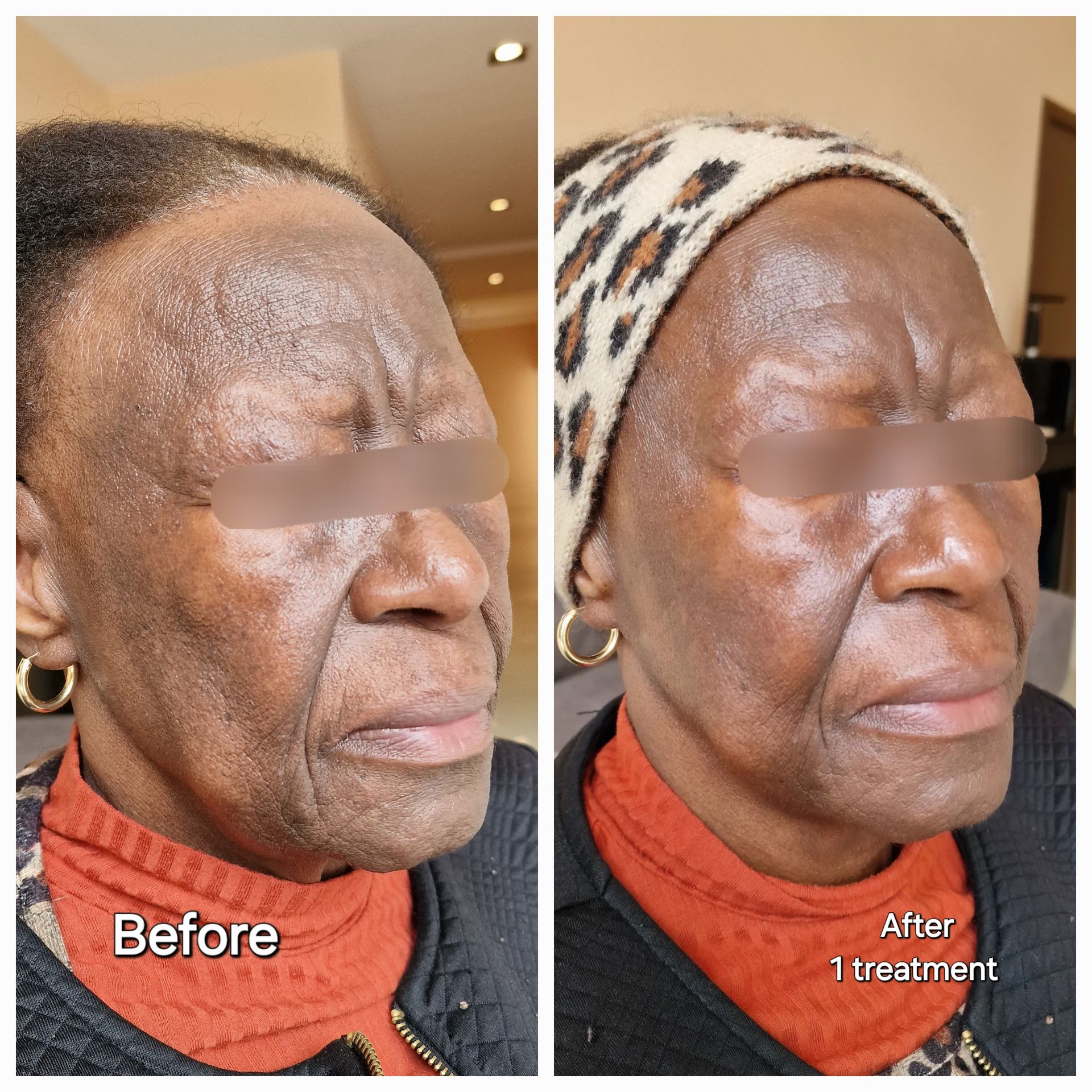 Hydrajet Before and After