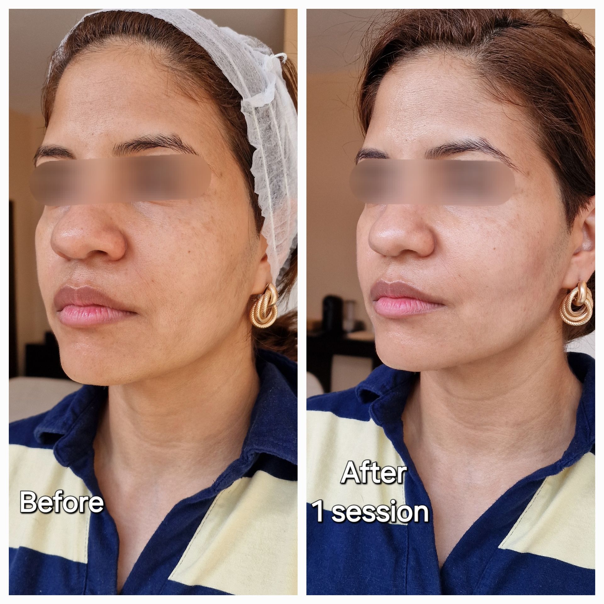 Hydrajet Before and After