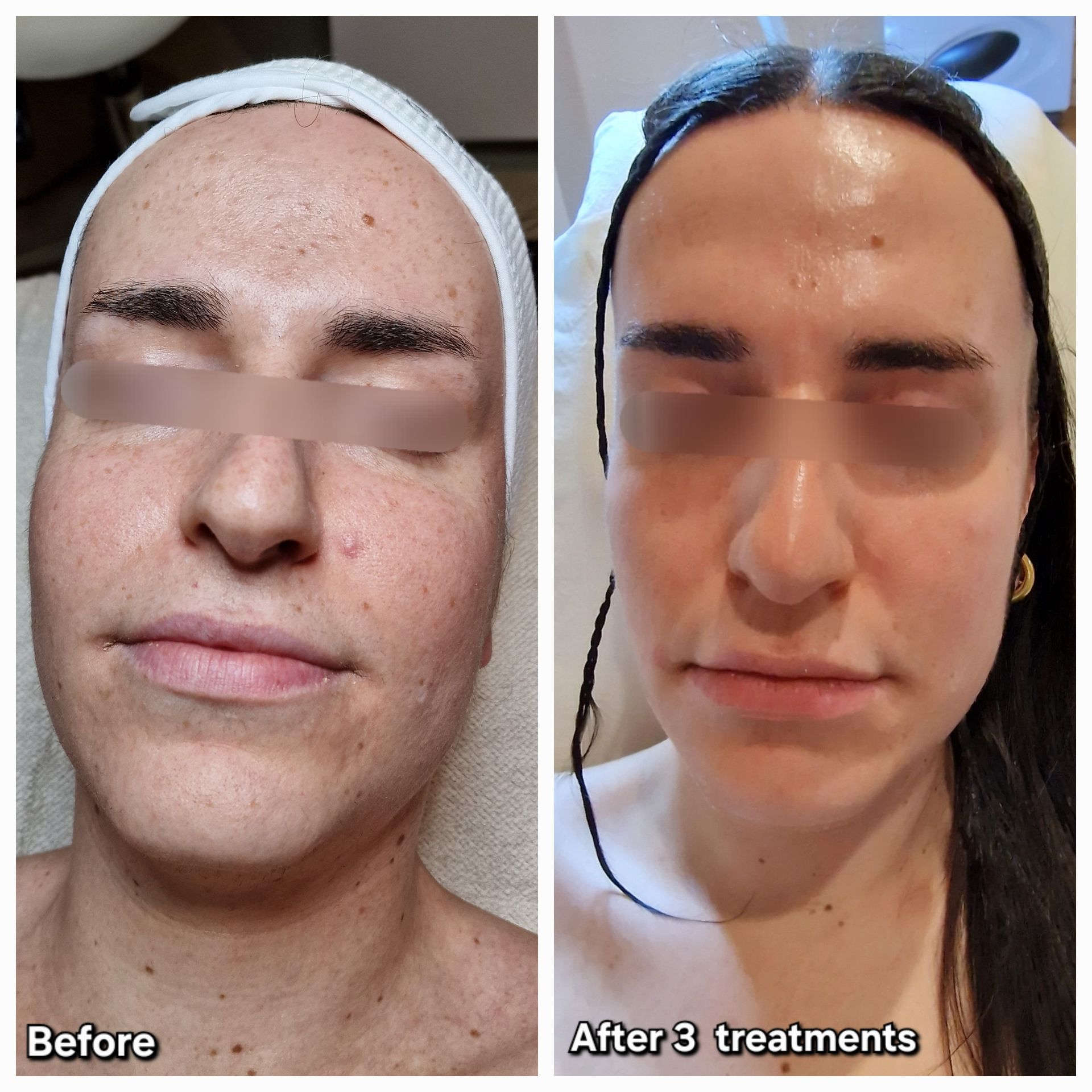 Before and after HydraJet case 1