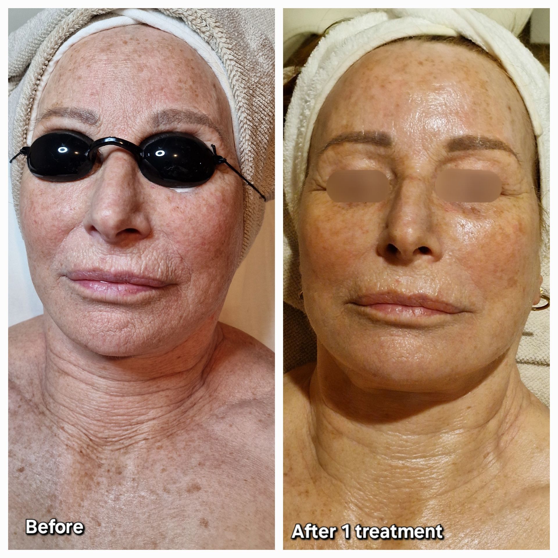 Before and after HydraJet case 3