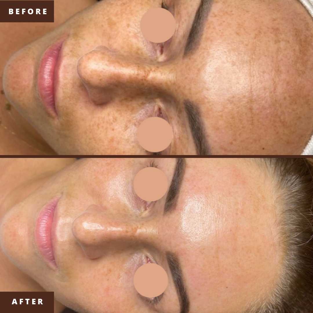 Calm premium treatment setting