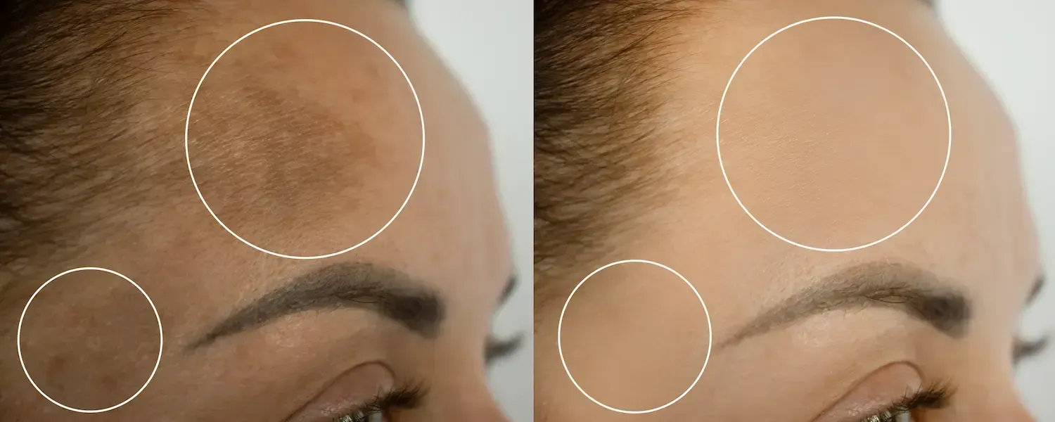 Hyperpigmentation before and after