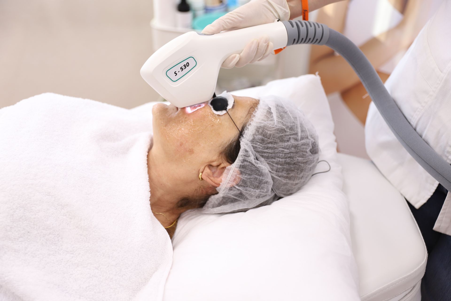 3d IPL laser on face