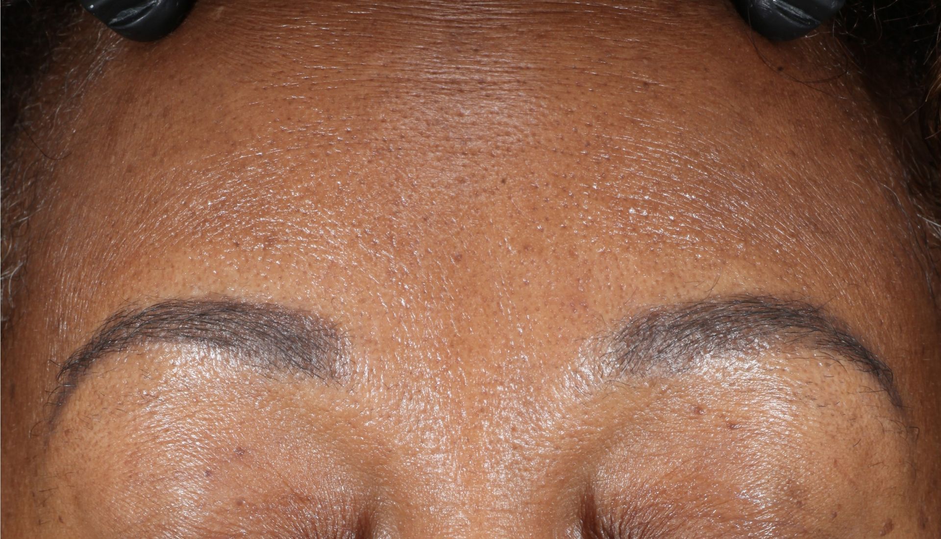 Before iS Clinical Brightening system