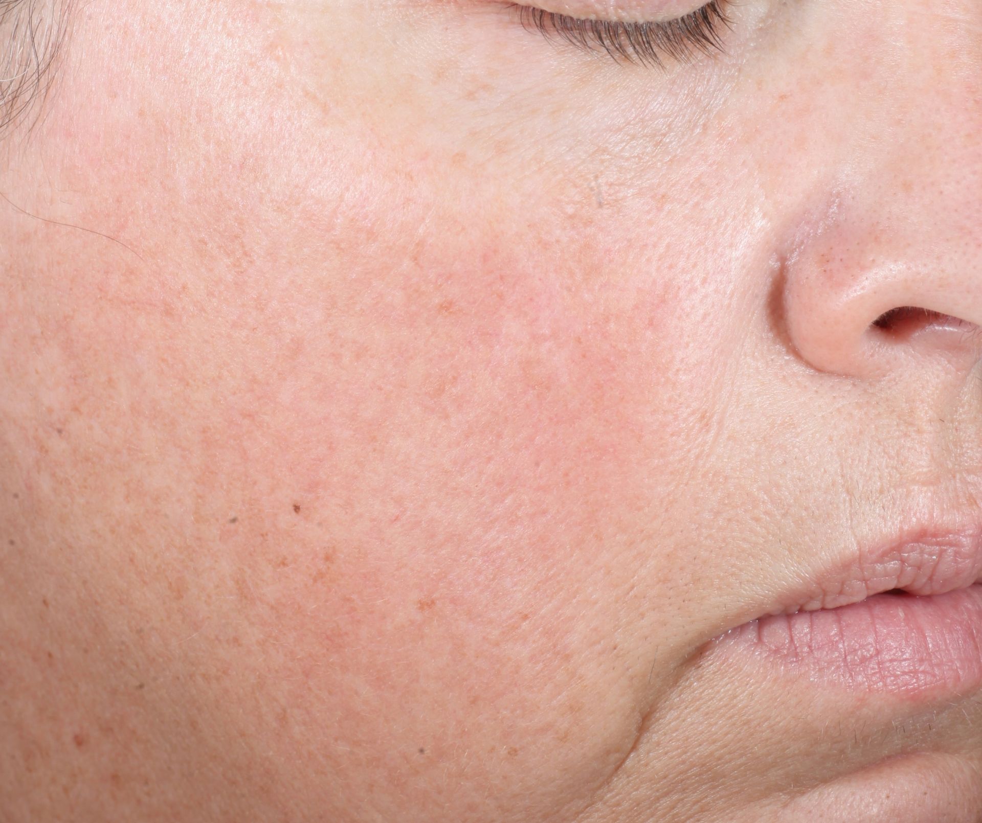 Before iS Clinical Brightening system
