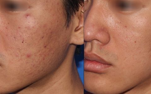 Before and After Acne 1