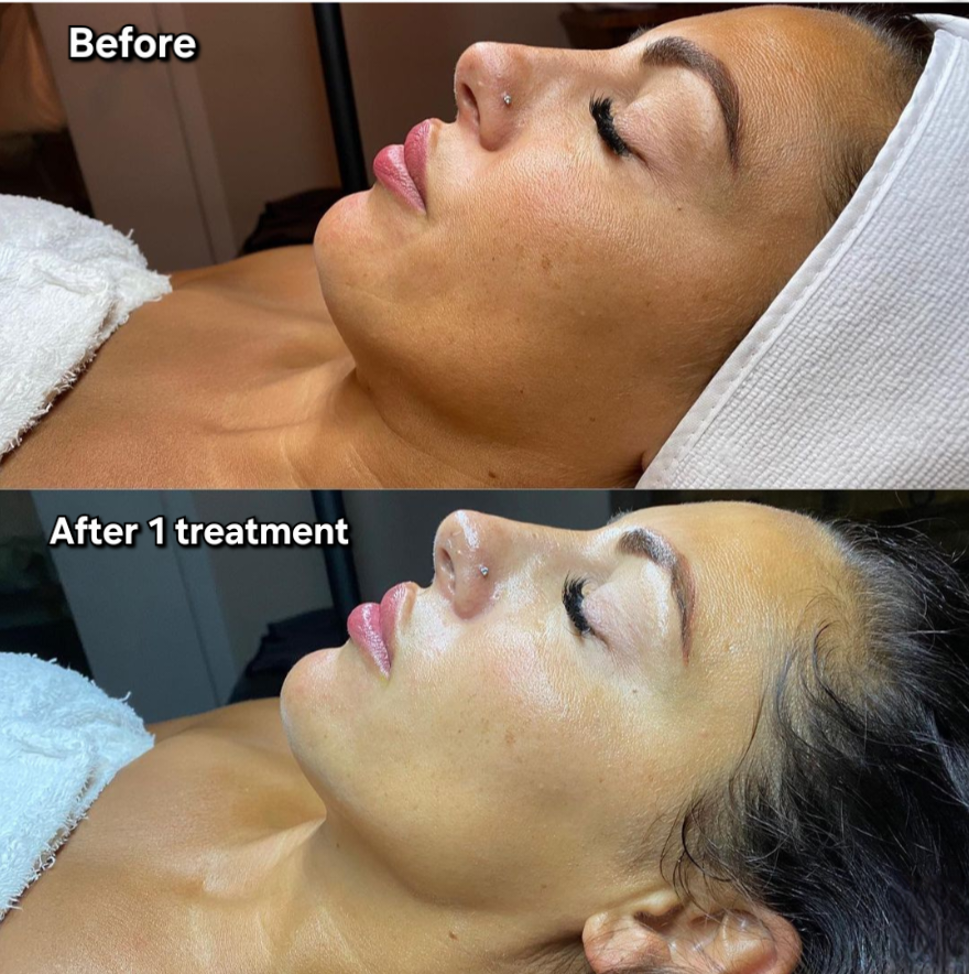 Voor en na OxyGeneo case 3