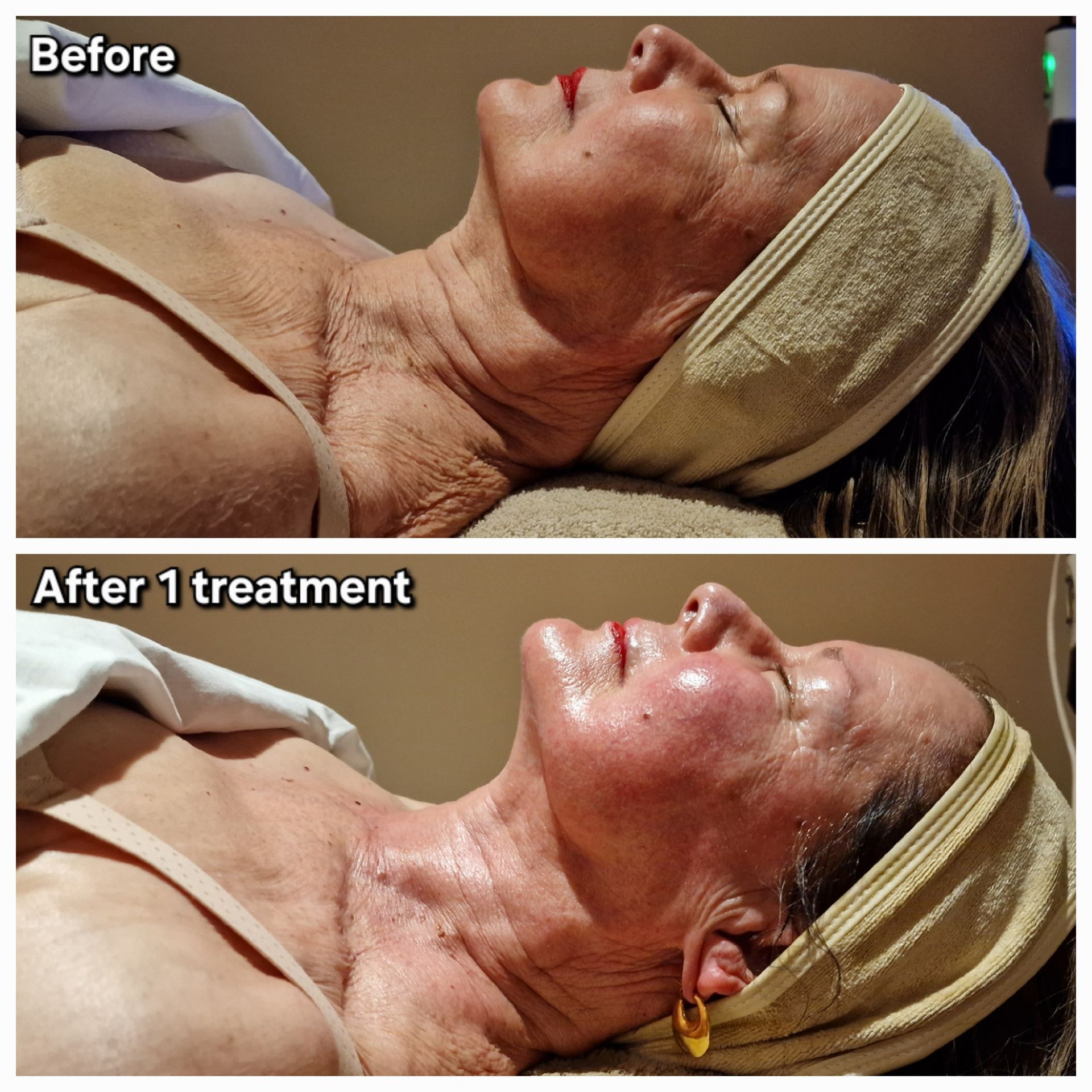 Voor en na OxyGeneo case 1