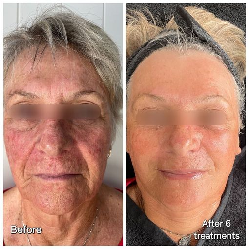 Before and after Gustil Facial Lifting