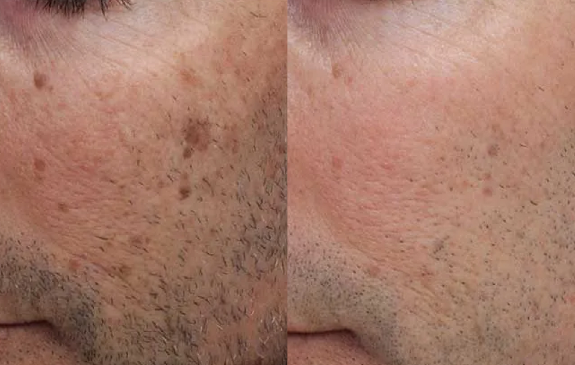 Before and after Hyperpigmentation 15