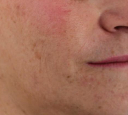 Hyperpigmentation Before Photobiodynamic treatment