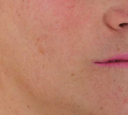 Hyperpigmentation after Photobiodynamic treatment