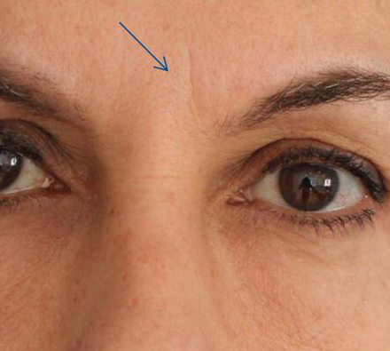 Wrinkles Before Photobiodynamic treatment