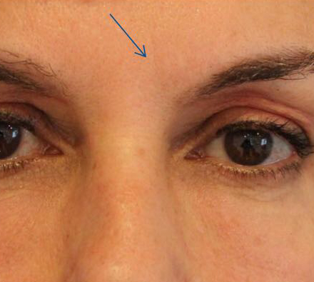 wrinkles after Photobiodynamic treatment