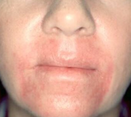 Couperose Before Photobiodynamic treatment