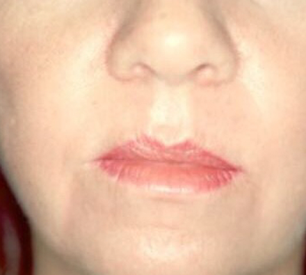 Couperose after Photobiodynamic treatment