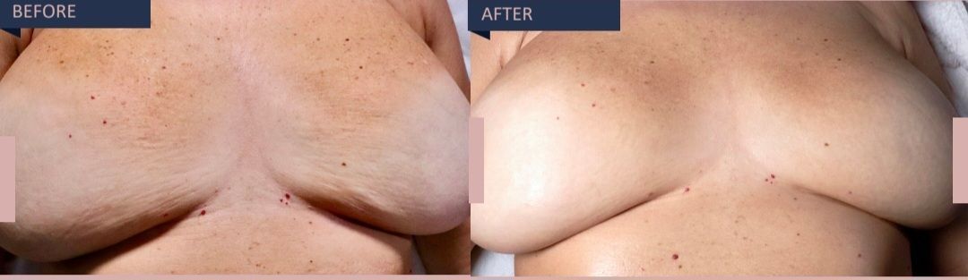 Stretch Marks Before and After 3