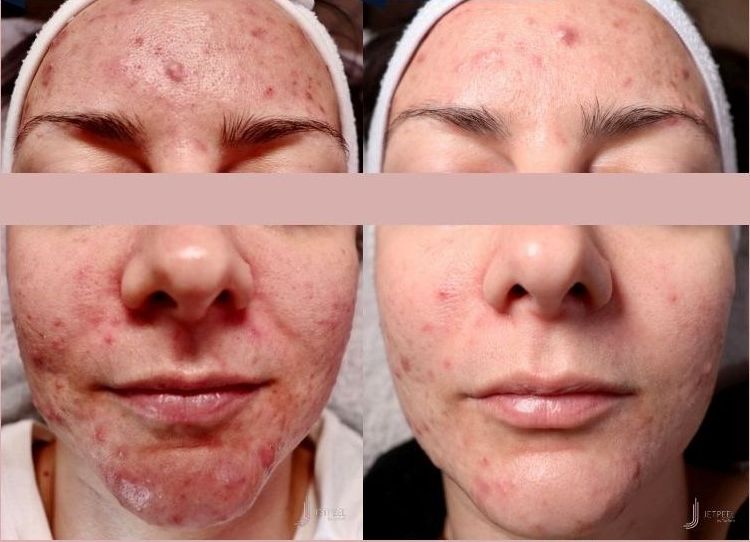 Rosacea or Couperose