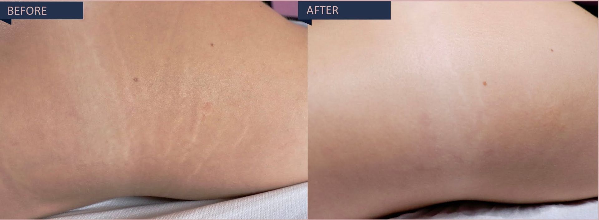 Stretch Marks Before and After 1