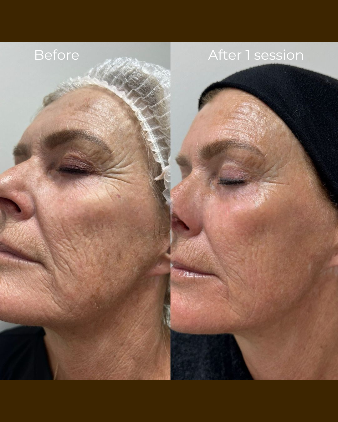 Voor en na huidverjonging