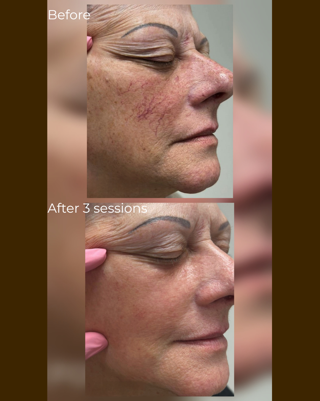 Voor en na stevigheid