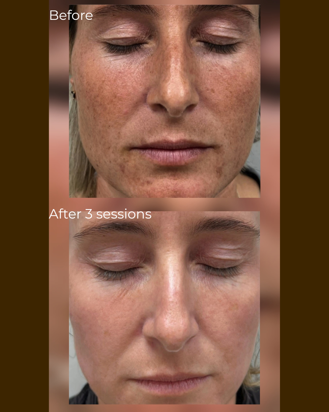 Voor en na huidhelderheid