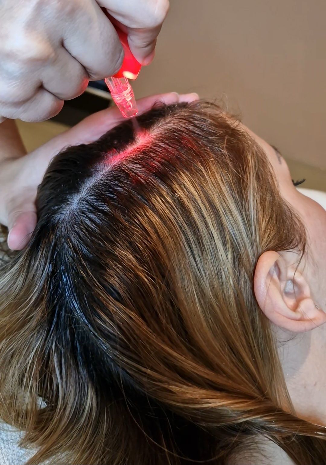 Scalp JetPeel