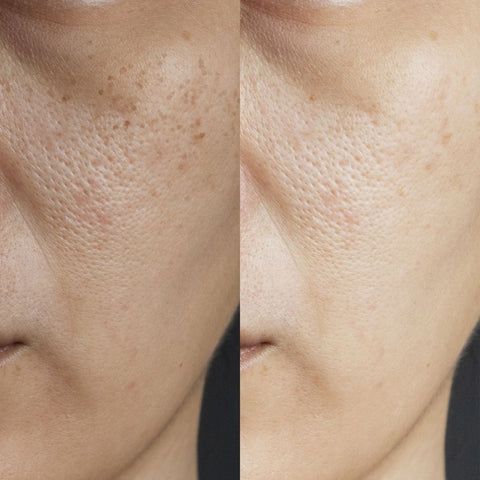 Before and after Hyperpigmentation 1
