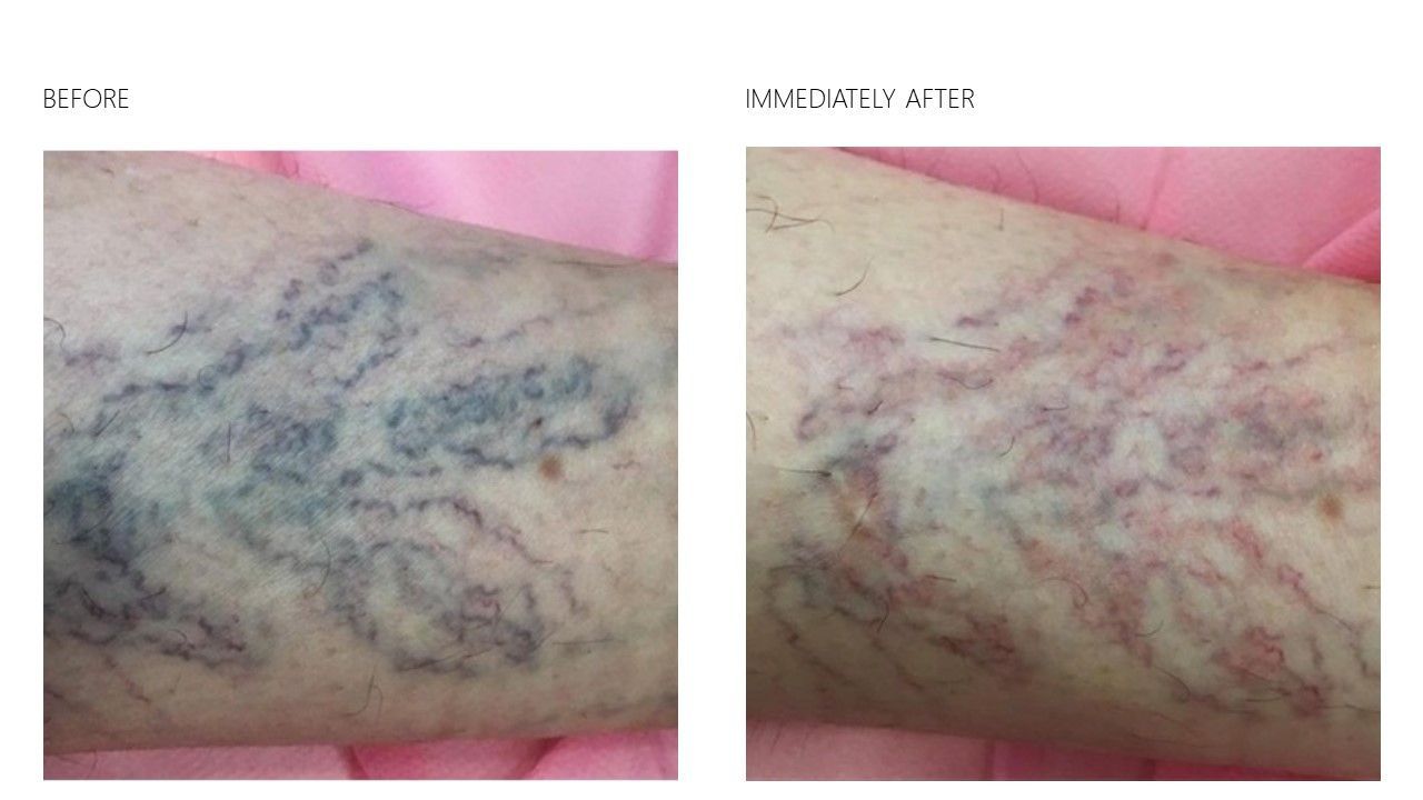 3D IPL laser treatment at Gustil Aesthetics