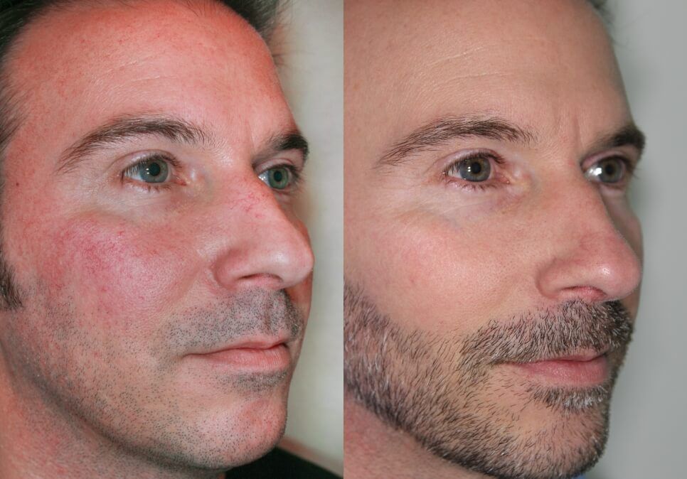 Rosacea redness before and after treatment