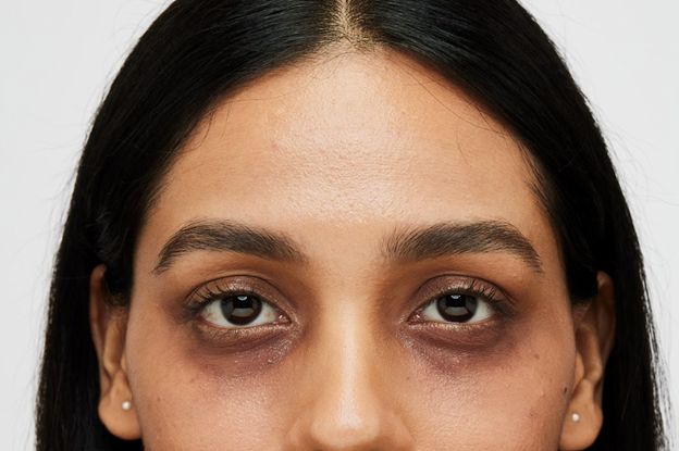 Lady with dark circles under eyes