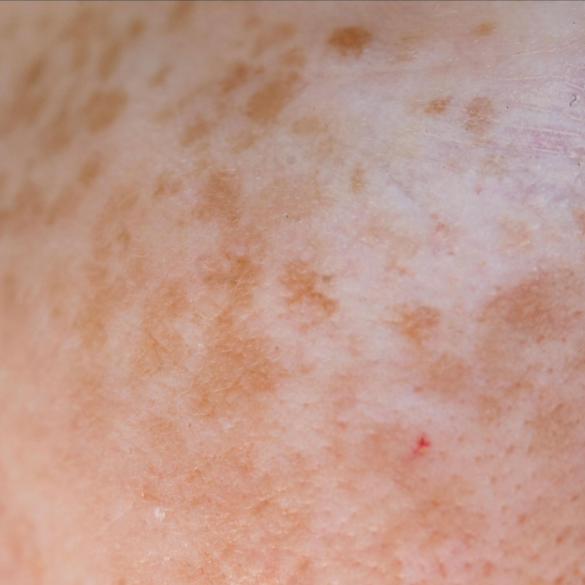 Hyperpigmentation Skincare Products