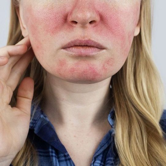 Redness Skincare Products