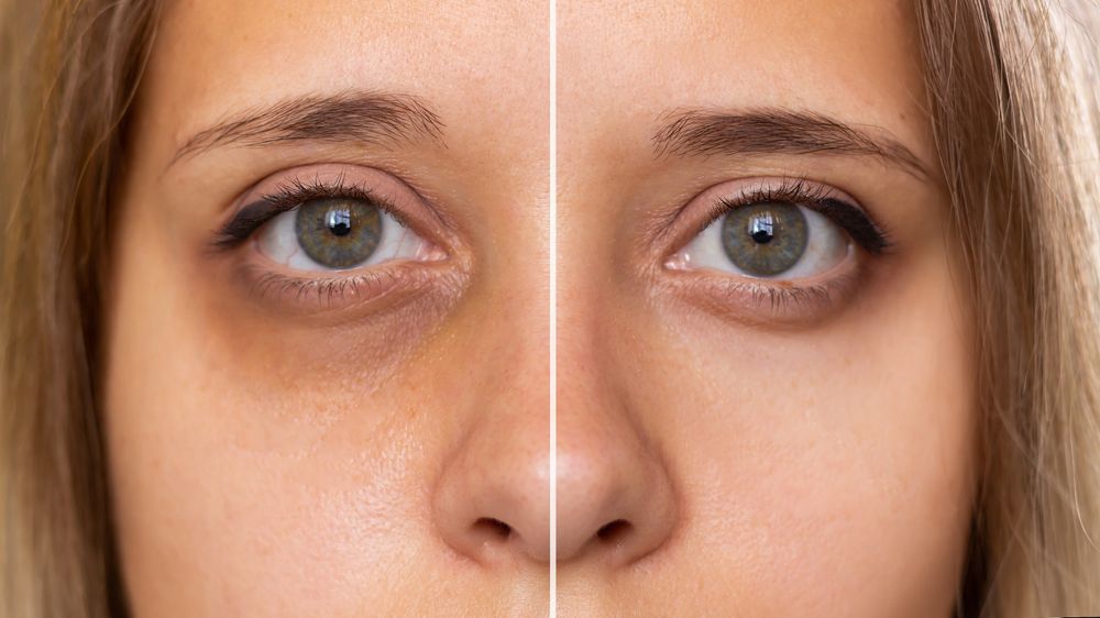 Dark Circles before After