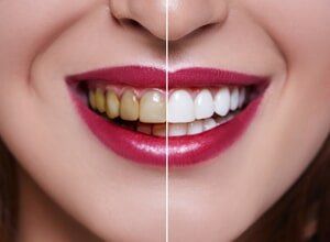 Woman Teeth Before and After Teeth Whitening— Prosthodontics in Beaumont, TX