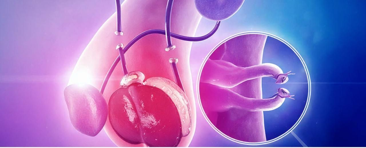 Reversão de Vasectomia