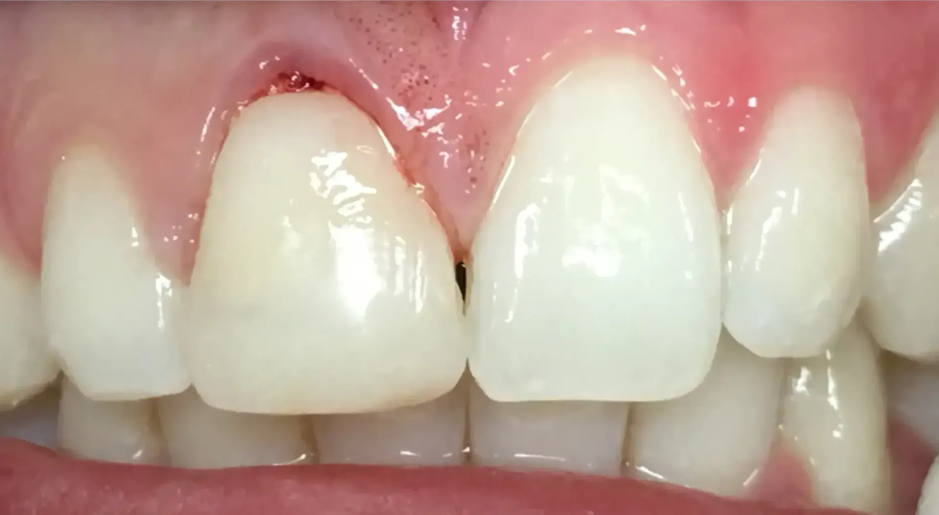 Before Bonding Replacement