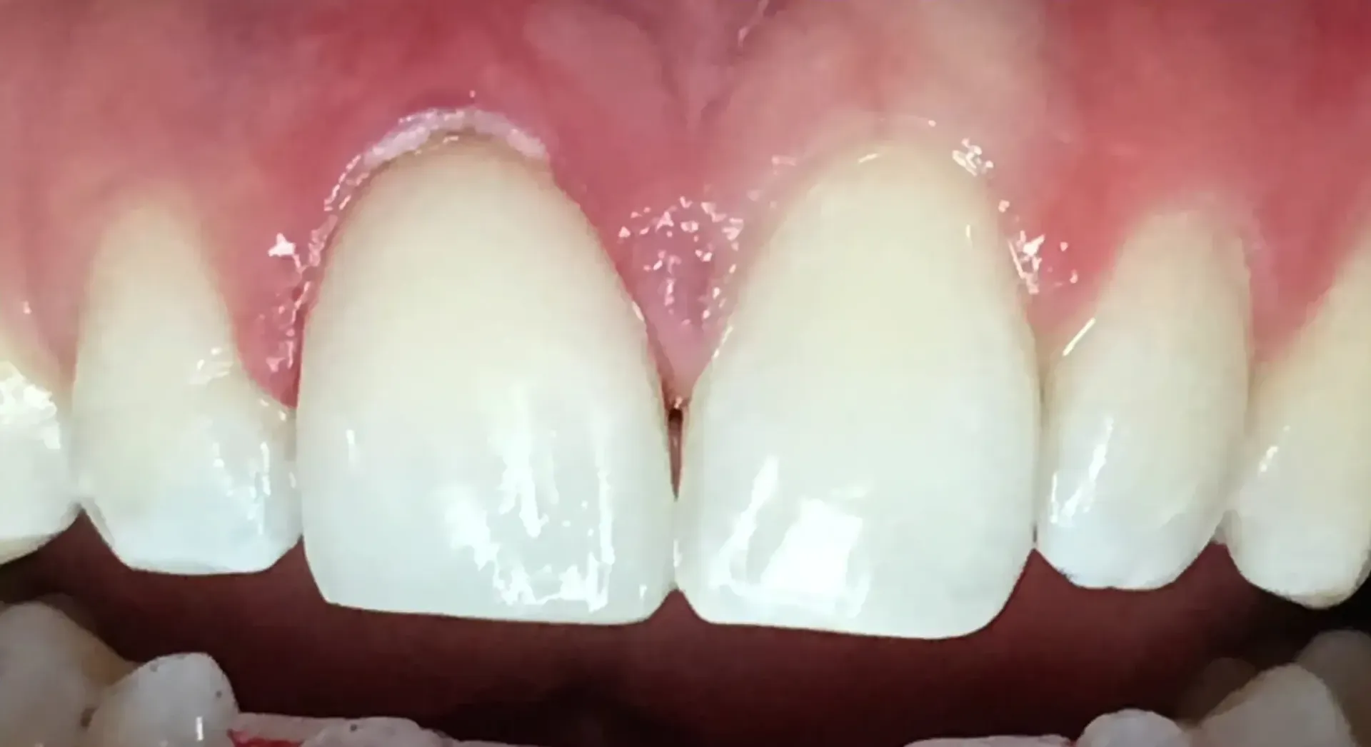 After Bonding Replacement
