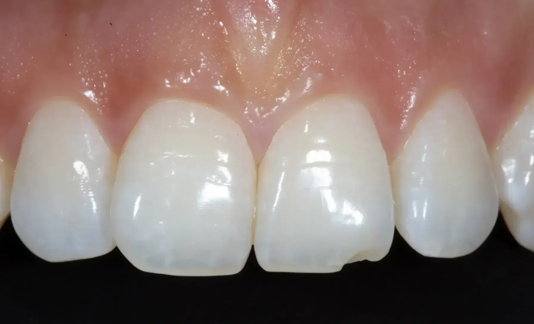 Before Chipped tooth repaired