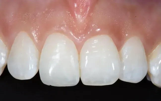 After Chipped tooth repaired