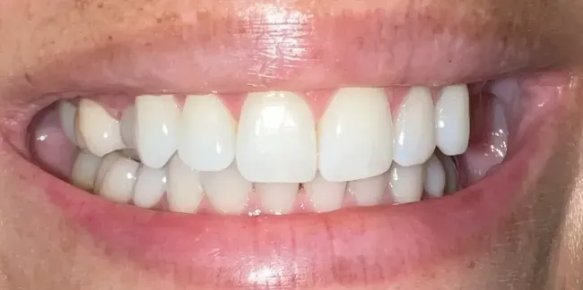 Before Composite Bonding