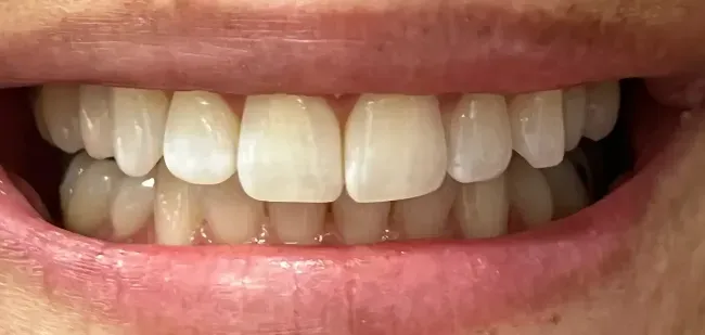 After Composite Bonding