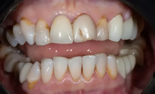 Before Ceramic Veneers