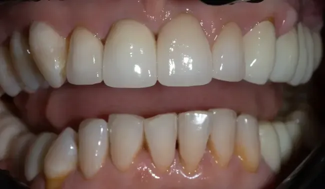 After Ceramic Veneers