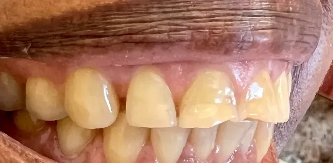 Before Full Ceramic Crowns on Worn Two Front Teeth