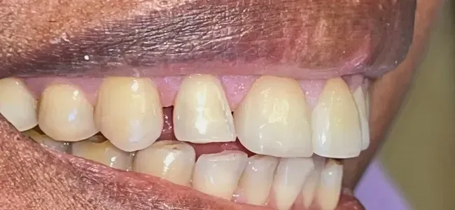 After Full Ceramic Crowns on Worn Two Front Teeth
